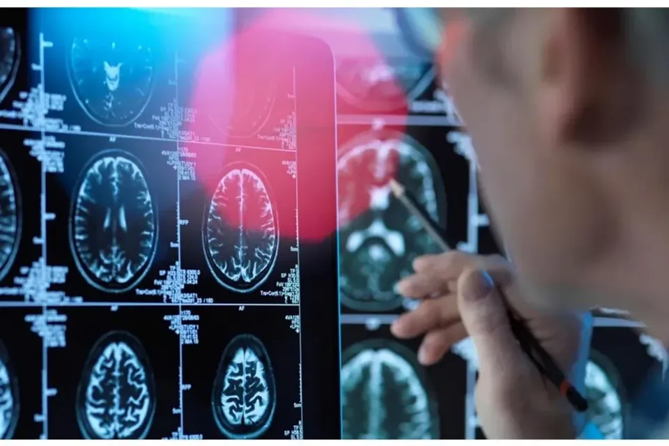 Stroke Rates Double Among Younger Adults