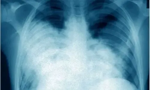 داء الفيالقة وراء مرض غامض أصاب 11 شخصاً وأودى بحياة أربعة في الأرجنتين
