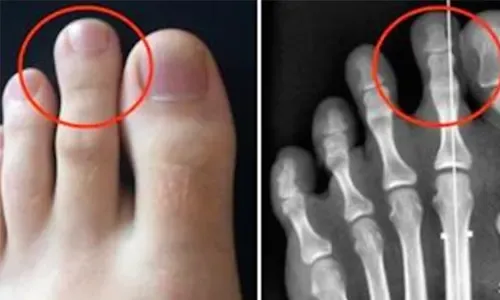 Do you have this? Is your second toe longer than your big toe?