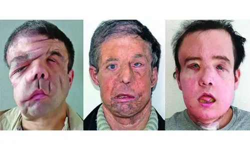 Frenchman gets 2nd face transplant