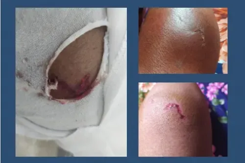 Late-night walk horror for Bahrain nurse attacked by stray dogs