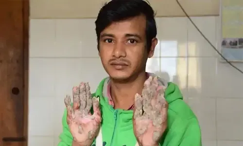 عودة "رجل الشجرة" البنغلاديشي إلى المستشفى بعد تدهور حالته
