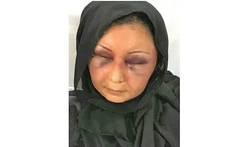 امرأة تروي تفاصيل اعتداء وحشي، والقبض على زوجها البحريني